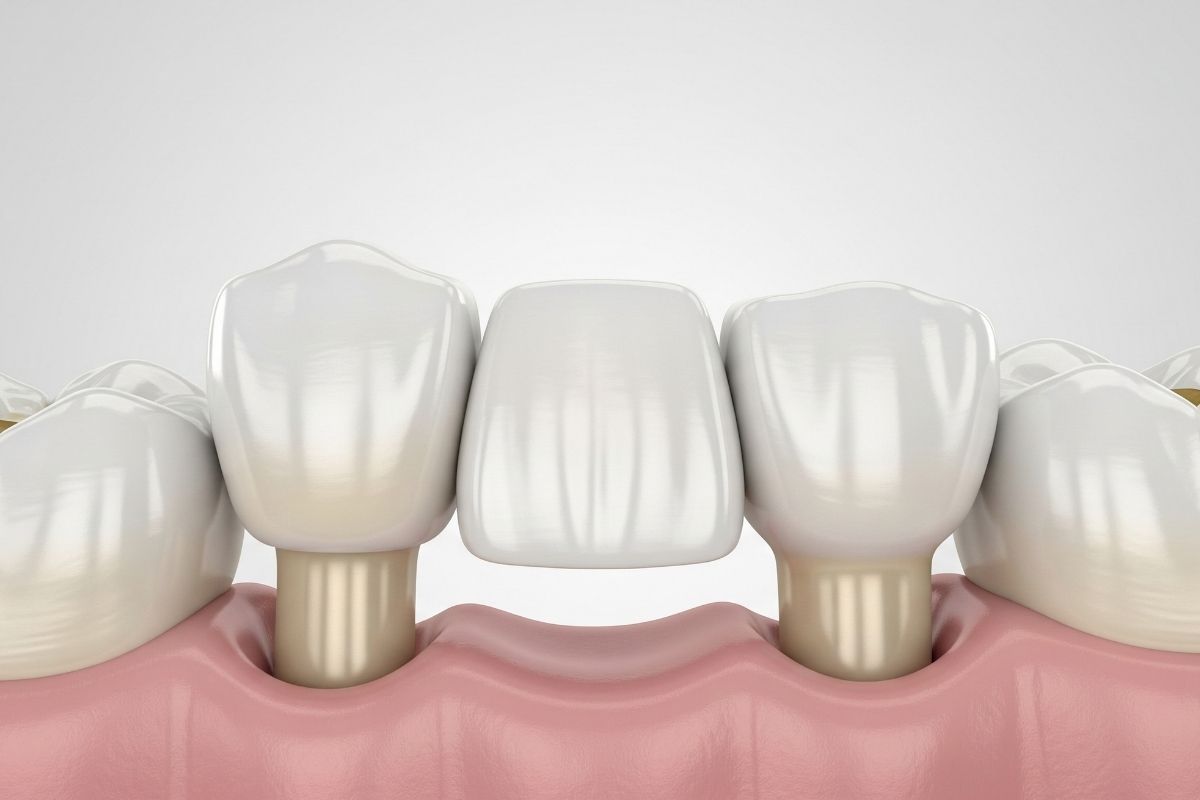 Dental Bridge