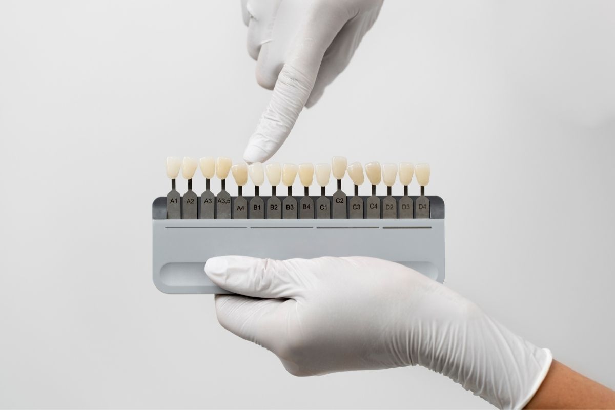 Laminate Veneers