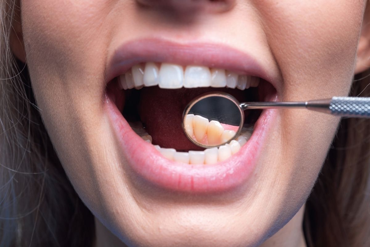 Composite Fillings