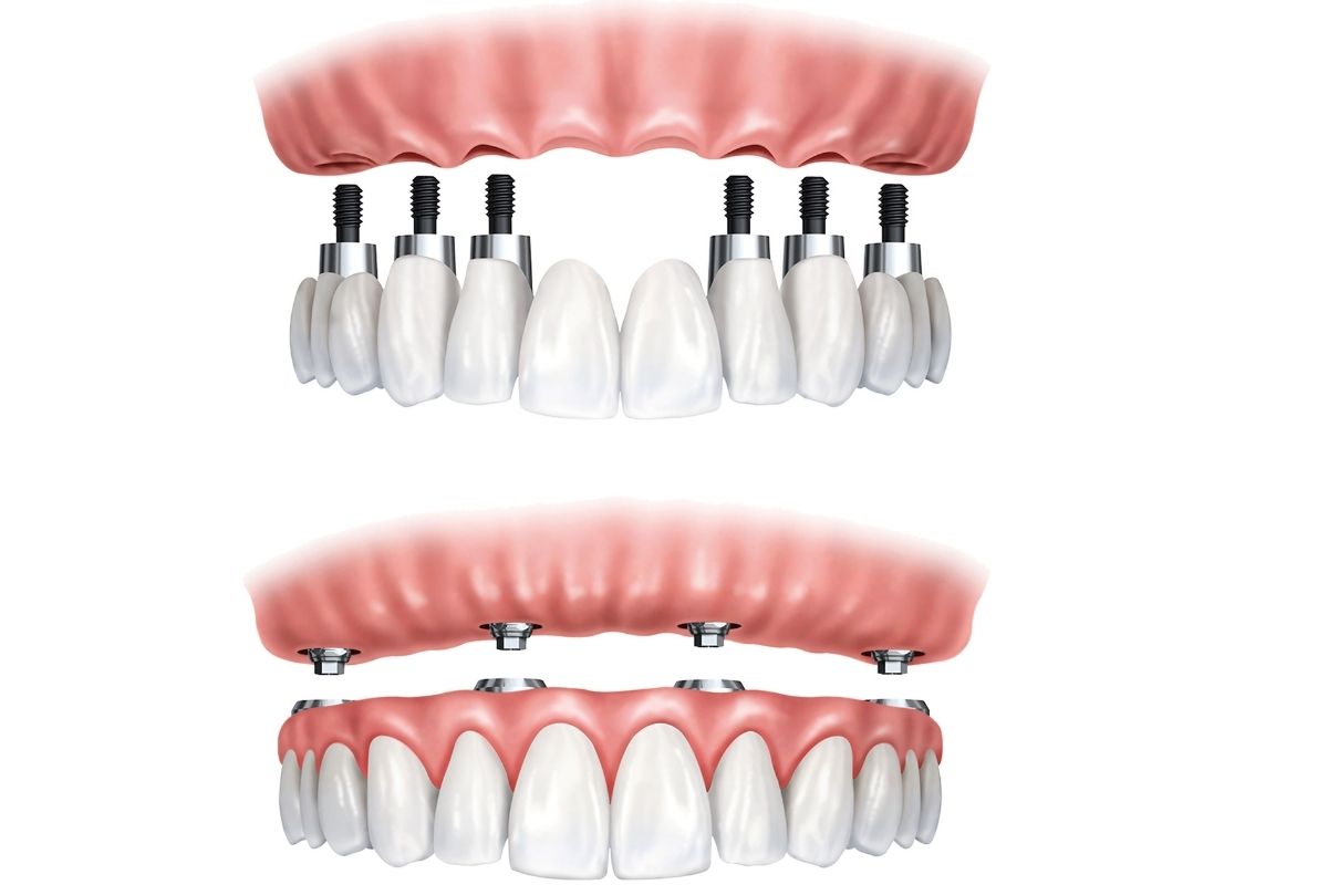All on 6 Dental Implants