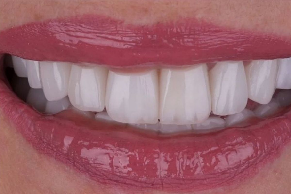 Laminate Veneers