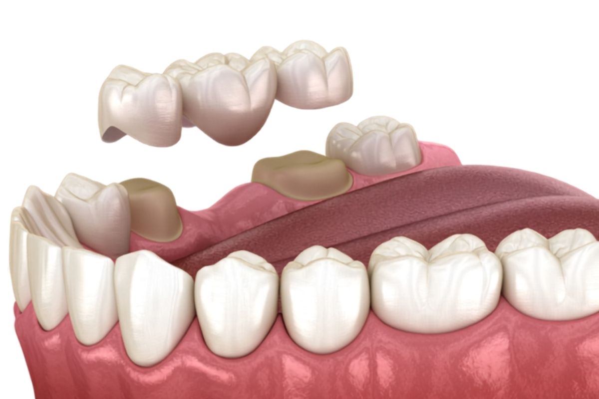 Dental Bridge