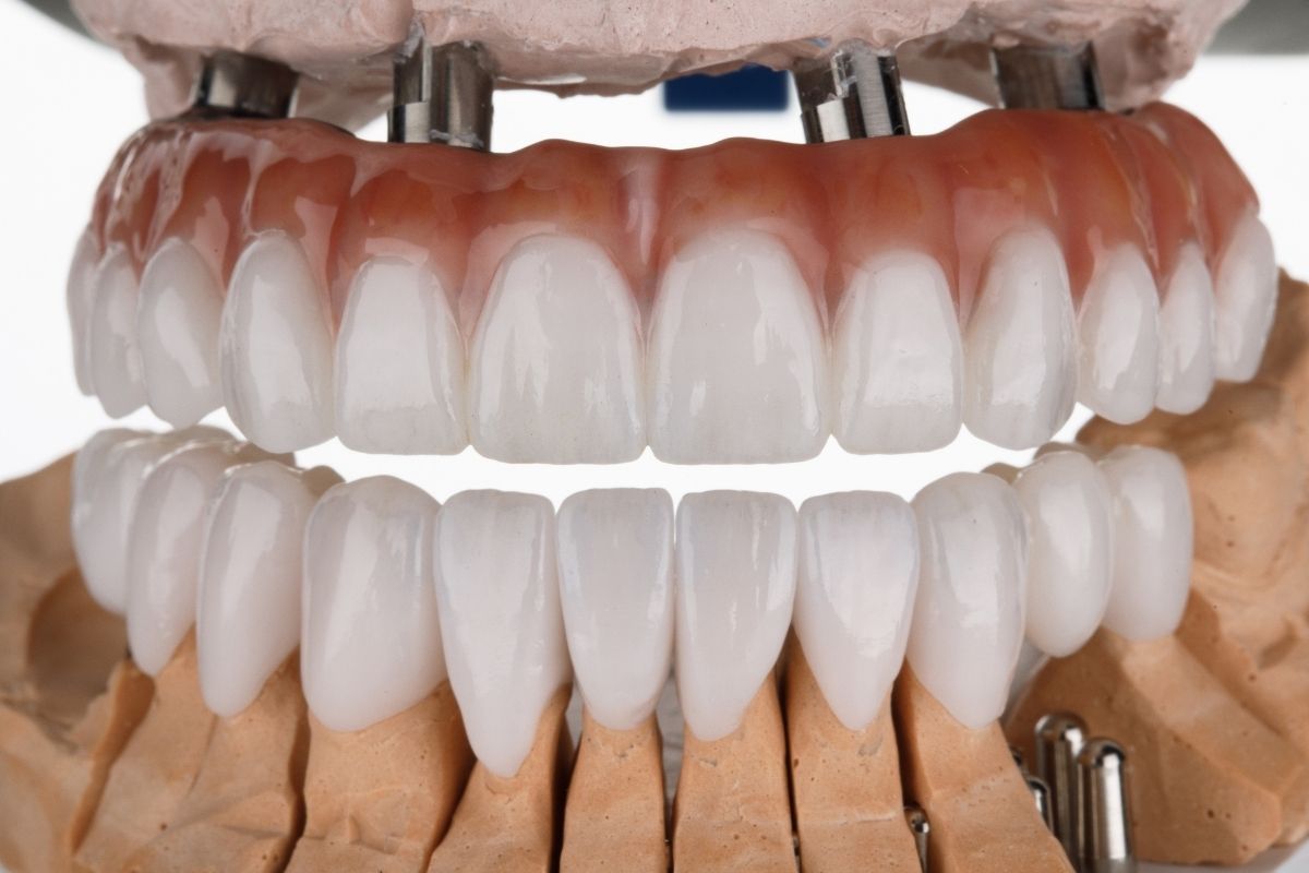 All on 4 Dental Implants
